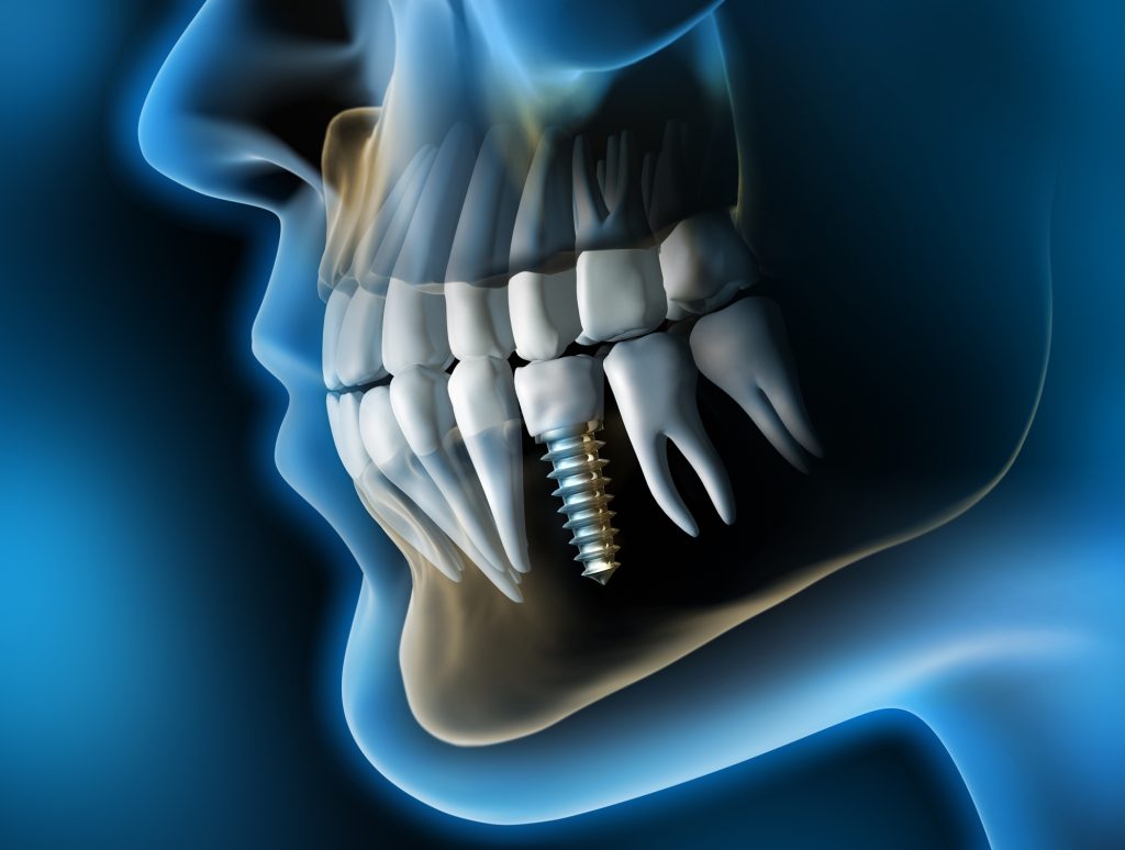 Complicaciones En Implantes Dentales