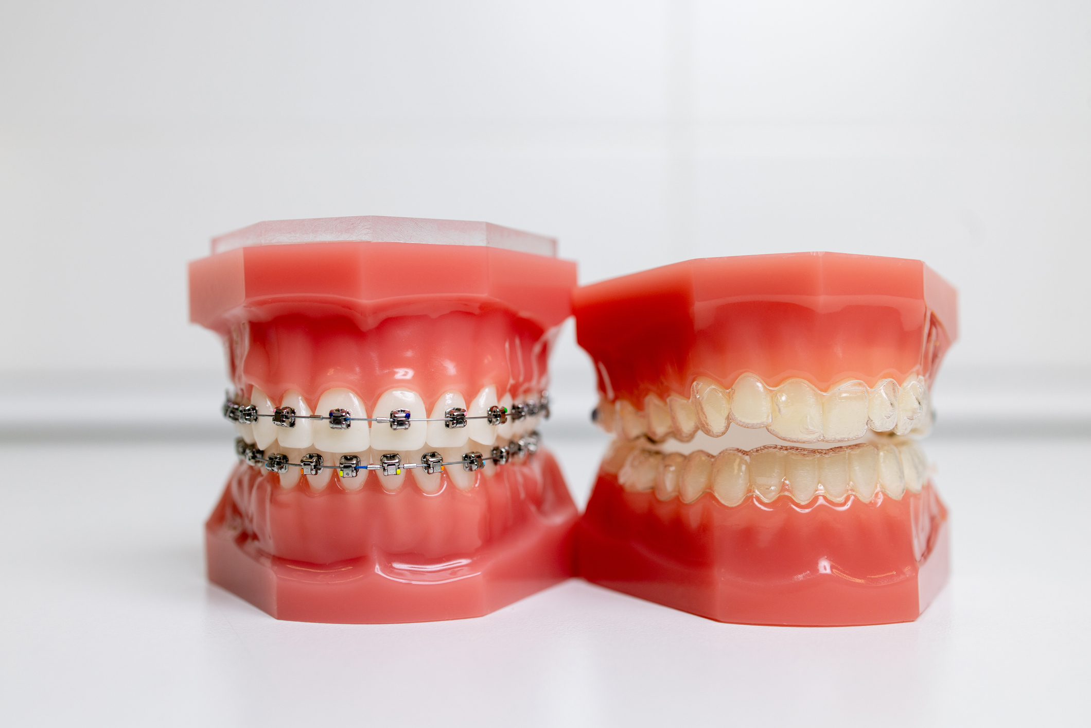 tratamiento de ortodoncia elegir