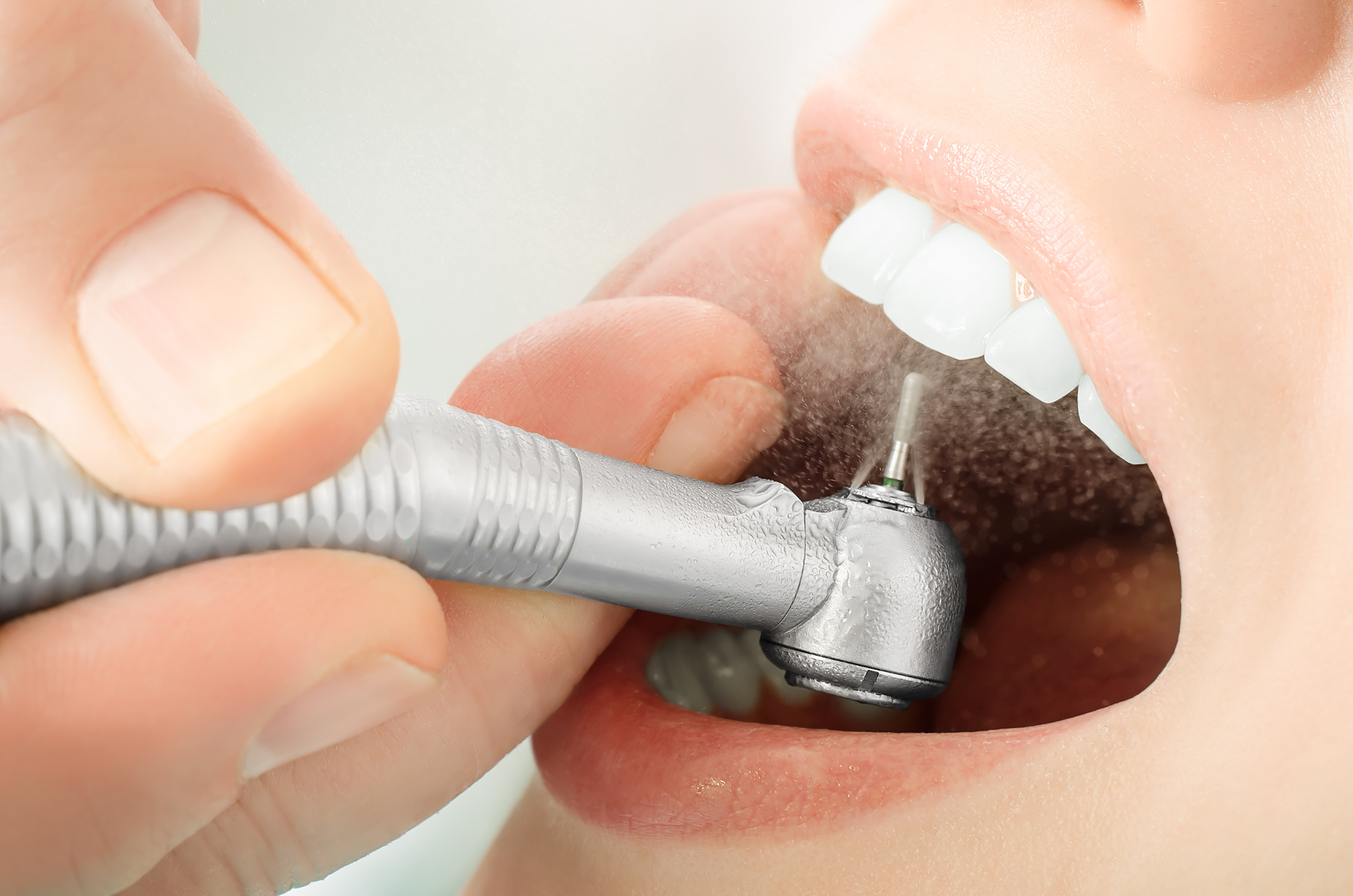 es importante la limpieza dental profesional