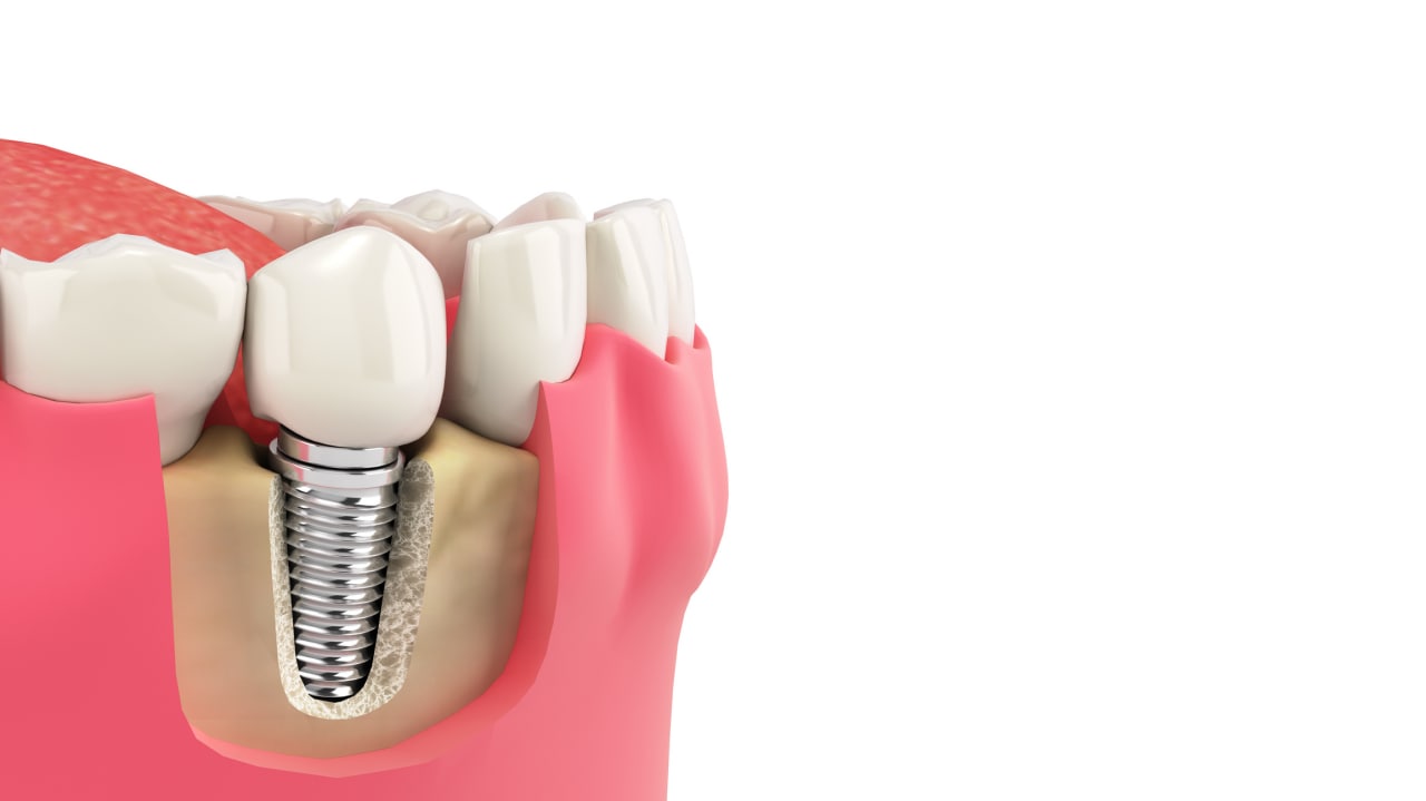 Enfermedad periimplantaria